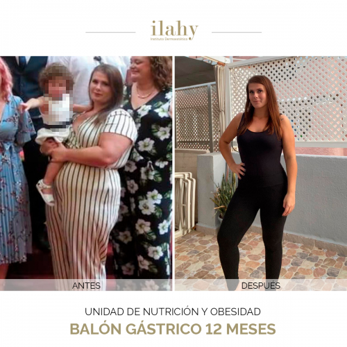 Bal�n g�strico 12 meses - P�rdida de 37 kilos